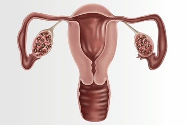 Acupuntura na Síndrome dos Ovários Policísticos SOP